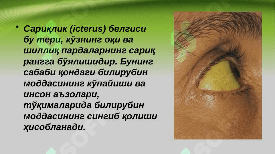 Sariqlikning biokimyoviy jihatdan differensial tashxisi 3