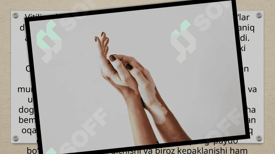 Vitiligoning zamonaviy davolash usullari 3