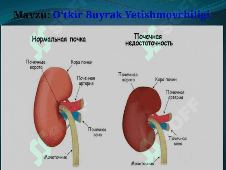 Oʻtkir Buyrak Yetishmovchiligi 2