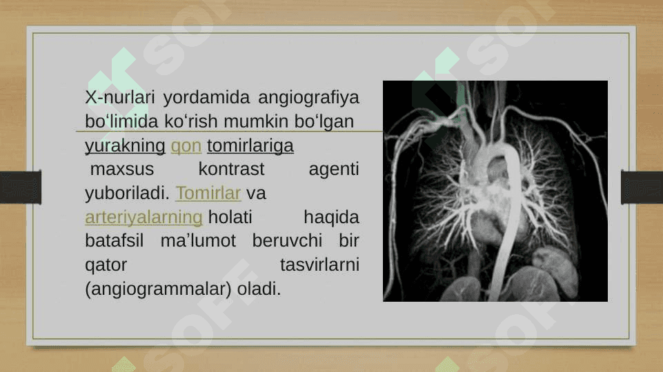 Koronar angiografiya 3