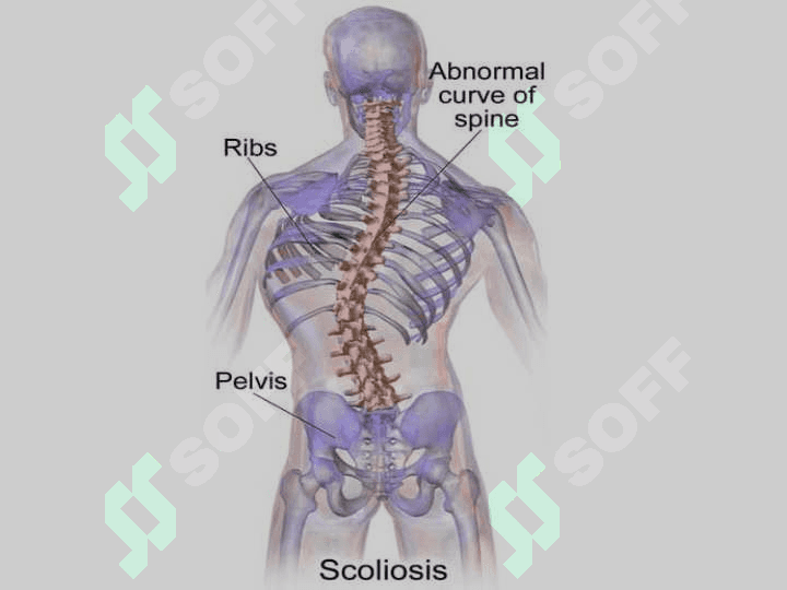 SKOLIOZ 6