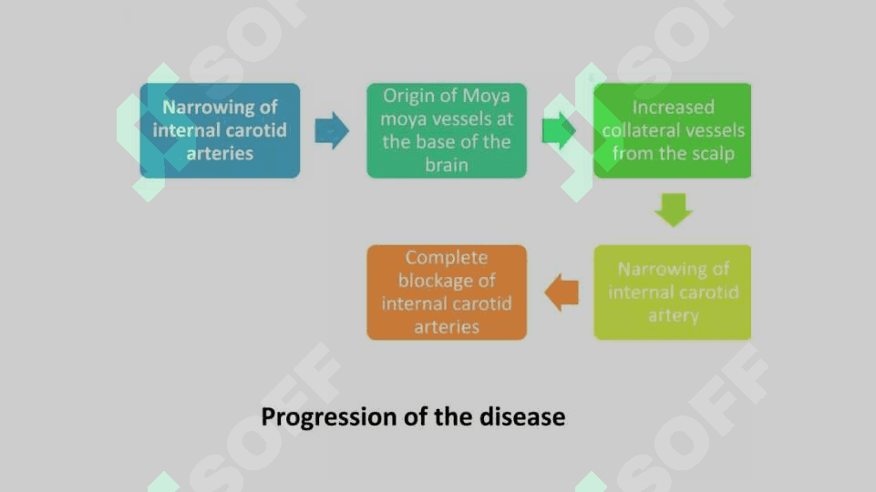 Moya Moya disease . Moya moya kasalligi 4