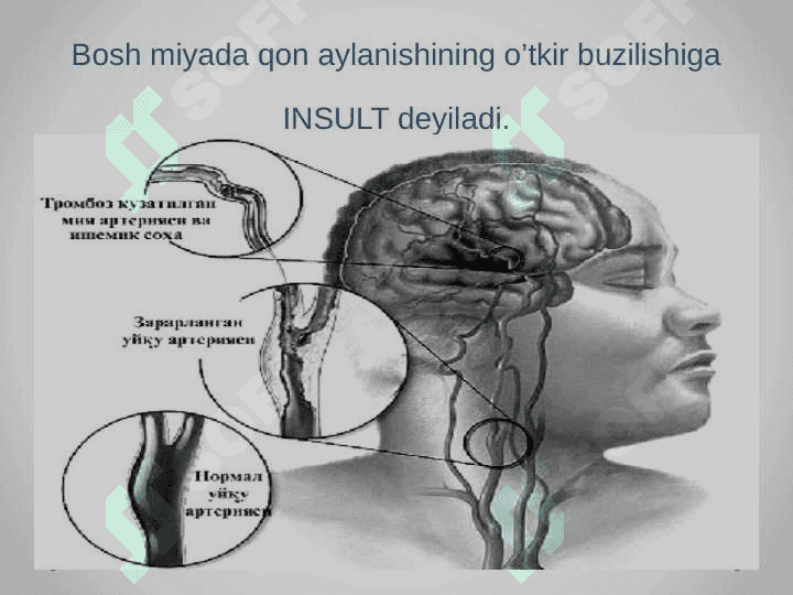 Ishemik insult 2