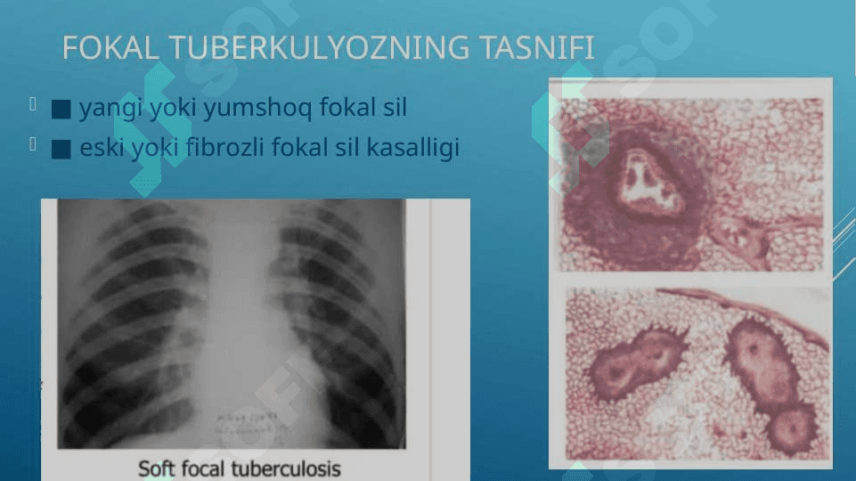 o’choqli tuberkulyoz tuberkulyoma 4