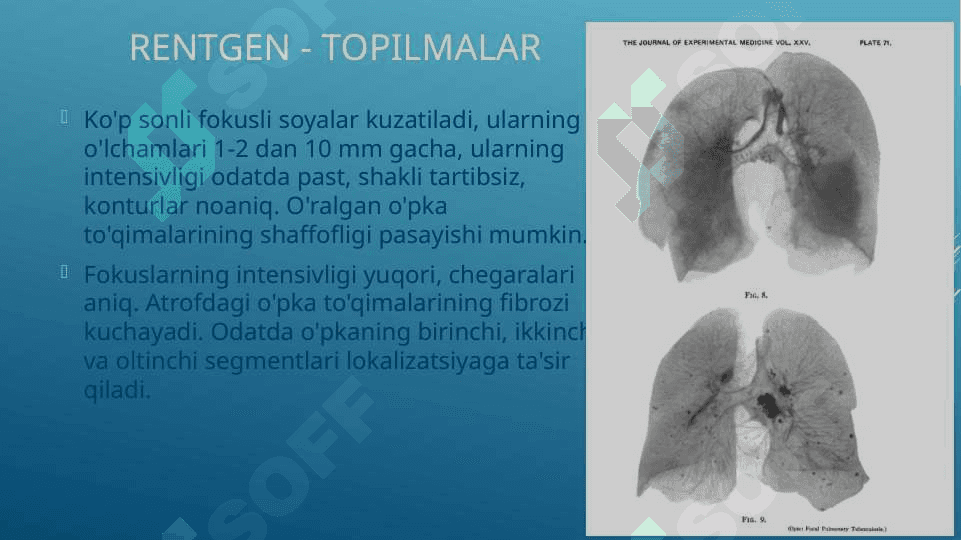 o’choqli tuberkulyoz tuberkulyoma 7