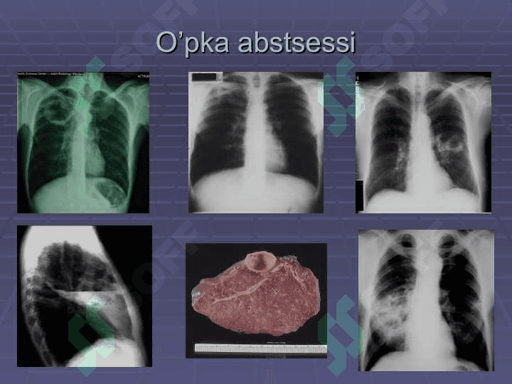 O’pka abssessi 7