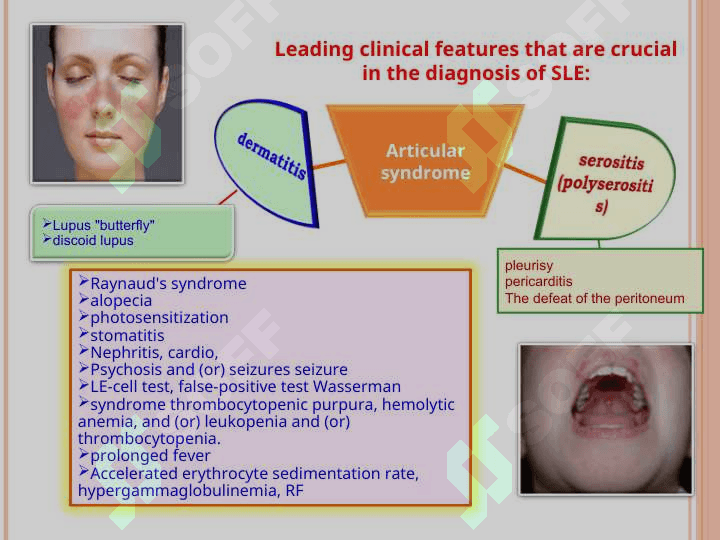 Differential diagnosis of diffuse connective tissue diseases. Tactics GPs. 7