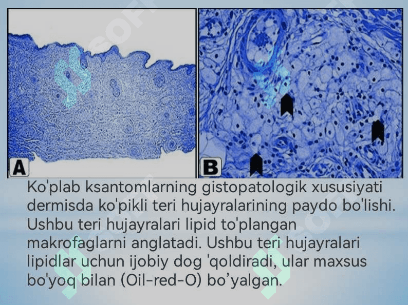 Ksantelazma. Lipoma. Gigroma 5