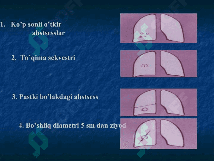 O’pka abssessi 6