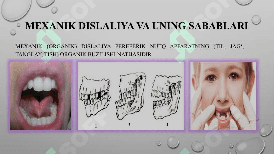 Dislaliya sabablari va shakllari, dislaliya turlari va uning namoyon bo‘lishi 4
