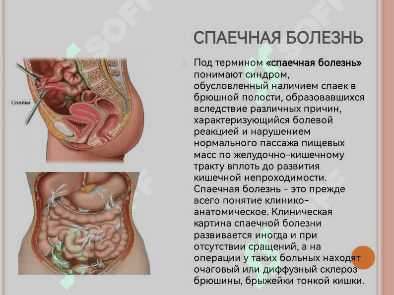 «Спаечная болезнь: Этиология, виды, лечение». 3