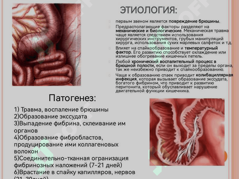 «Спаечная болезнь: Этиология, виды, лечение». 4