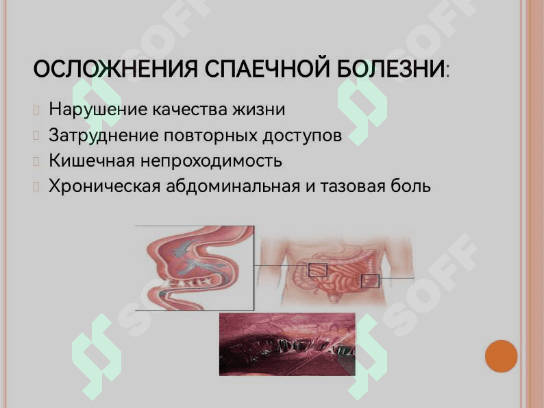 «Спаечная болезнь: Этиология, виды, лечение». 7