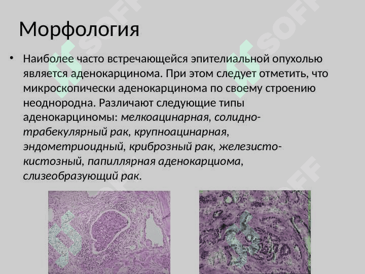 Рак предстательной железы 6