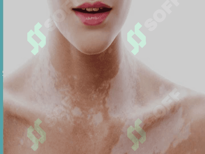VITILIGO HAQIDA 2