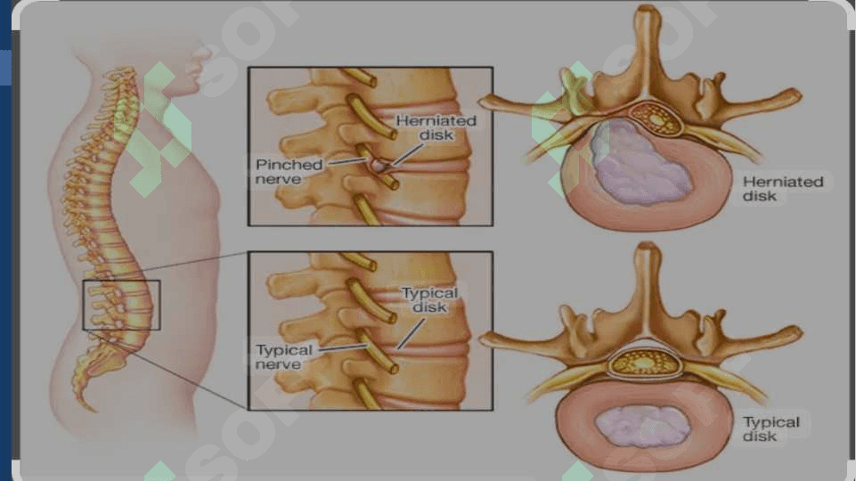 Umurtqalararo osteoxondroz, spondilyoz, spondiloartroz 4