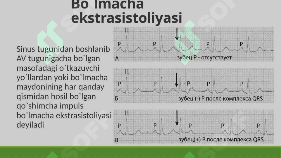 yurak aritmiyalarining ekg tasnifi va ko’rinishi 4