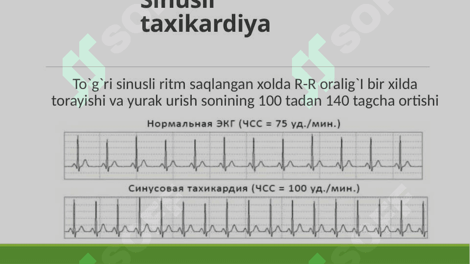 yurak aritmiyalarining ekg tasnifi va ko’rinishi 5