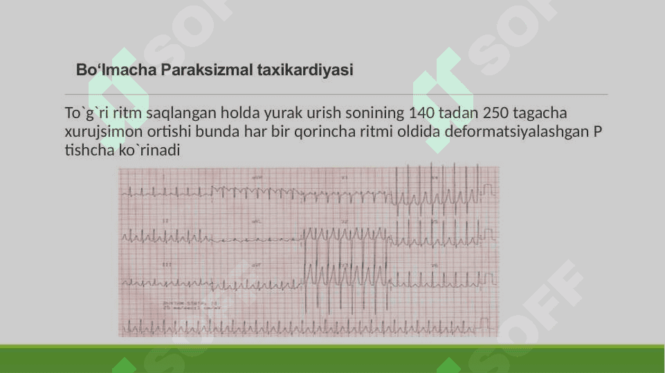 yurak aritmiyalarining ekg tasnifi va ko’rinishi 6
