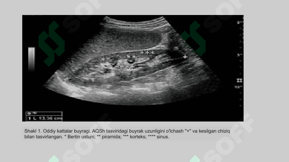 Buyrak ultratovush tekshiruvi - Renal ultrasonography 6
