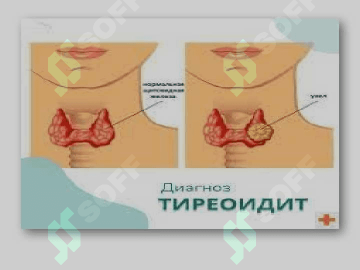 Tireoiditlar 7