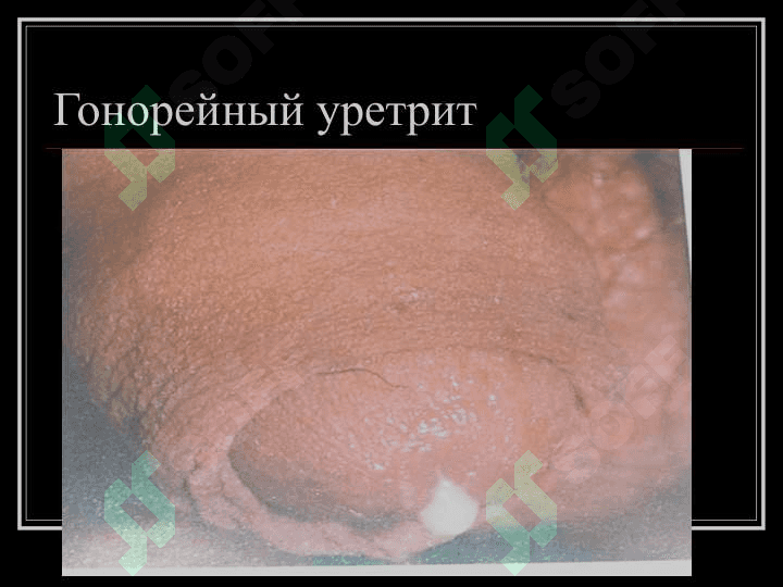 Гонорея 8