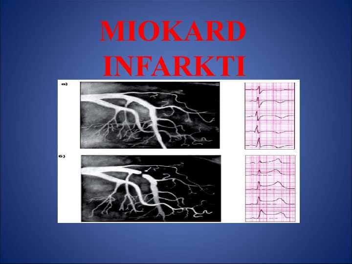 MIOKARD INFARKTI