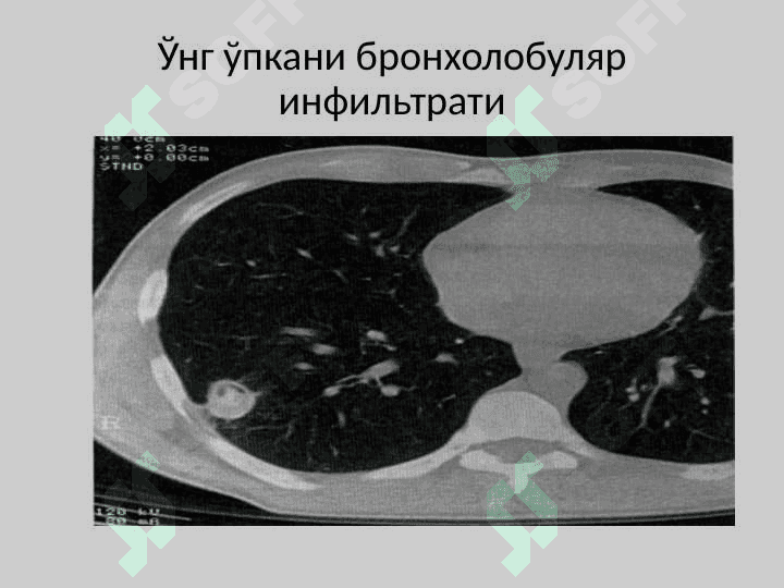 Ўнг ўпкани бронхолобуляр инфильтрати 2