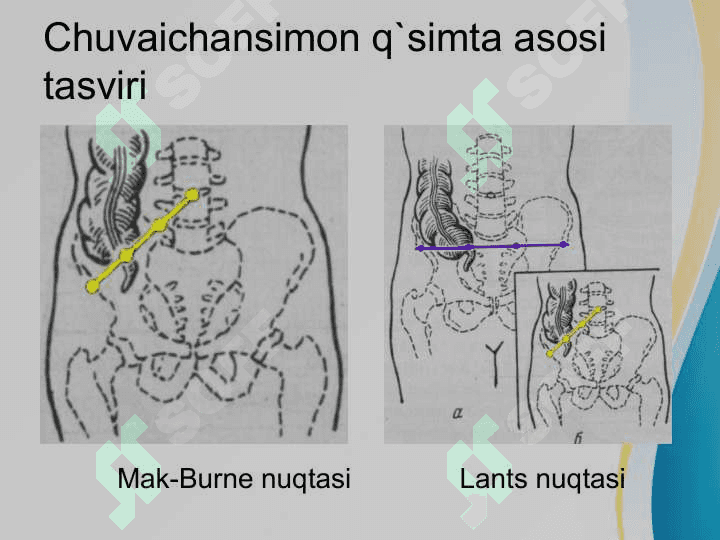 Qorin old va yon devori churralari va ularda operatsiyalar 4