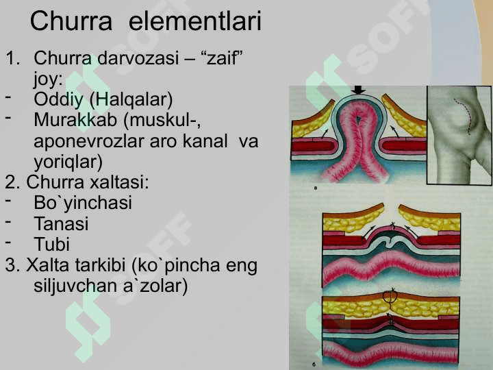 Qorin old va yon devori churralari va ularda operatsiyalar 7