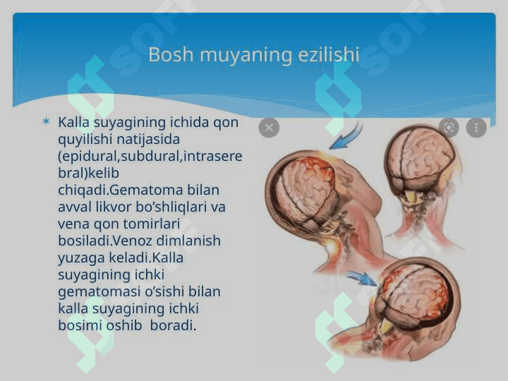 BOSHMIYA TRAVMALARI va Bosh miya travmalari nur diagnostikasi 3
