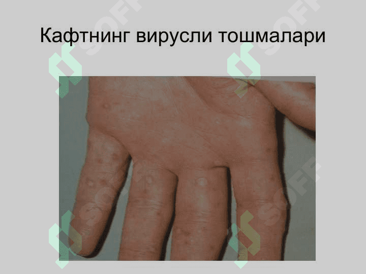 Терининг вирусли касалликлари 6
