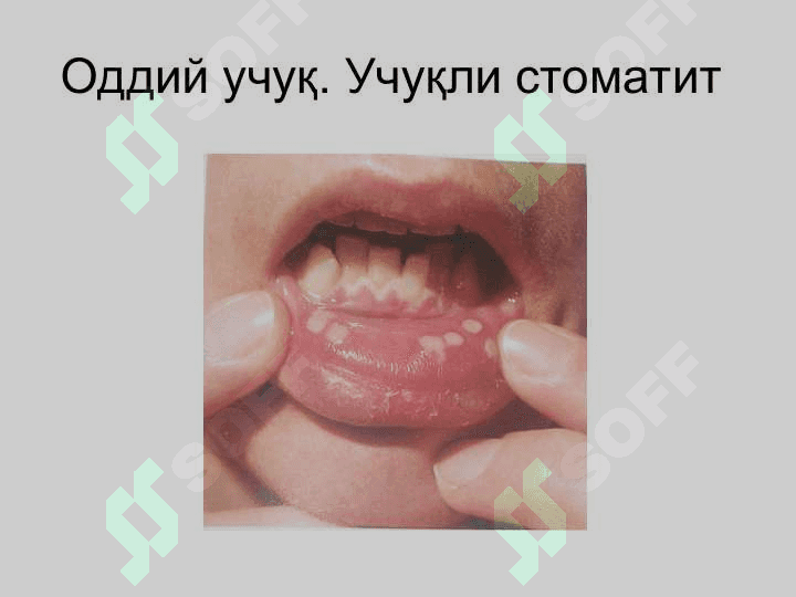 Терининг вирусли касалликлари 8