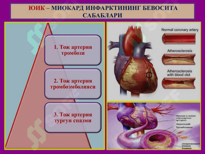 ЮРАК ИШЕМИК КАСАЛЛИГИ - ЮИК 3