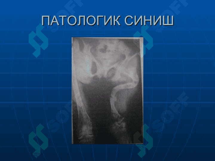 Суякларнинг синиши ва чикиши 8