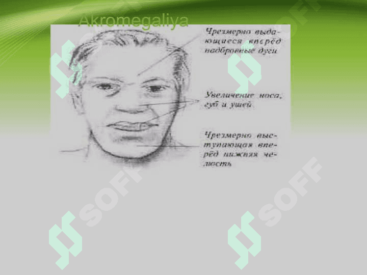 Akromegaliya 3