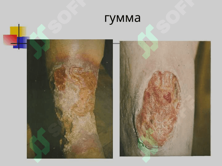 Учламчи ва тугма Захм(Lues, Syphilis) 7