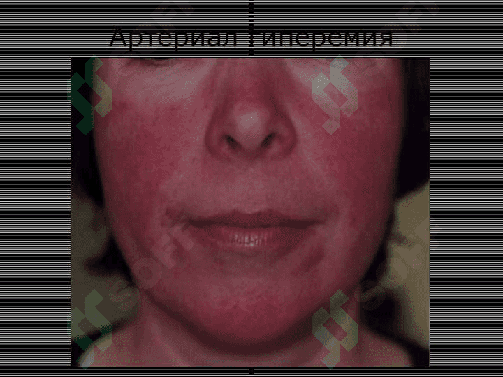 PERIFERIK QON AYLANISHINING BUZILISHLARI 8
