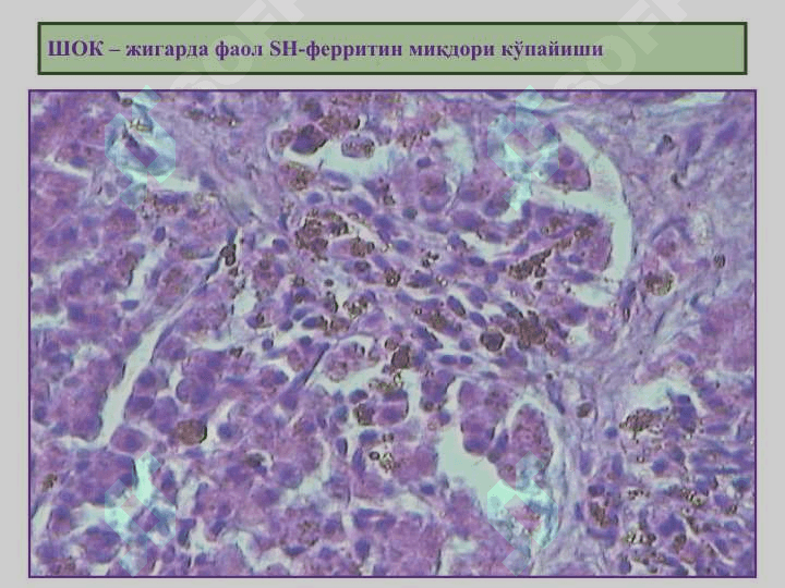 “Аралаш дистрофиялар” “Смешанные дистрофии»   «THE MIXED DYSTROPHIES” 4