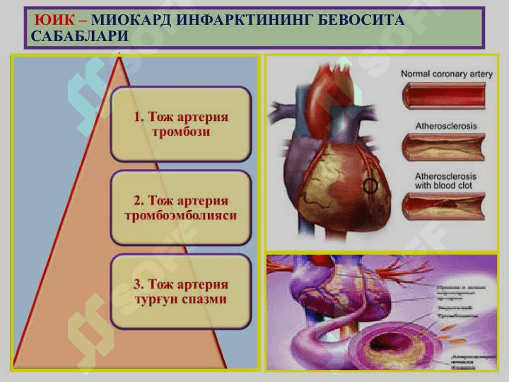 “Юрак ишемик касаллиги. Цереброваскуляр касаллик” 4