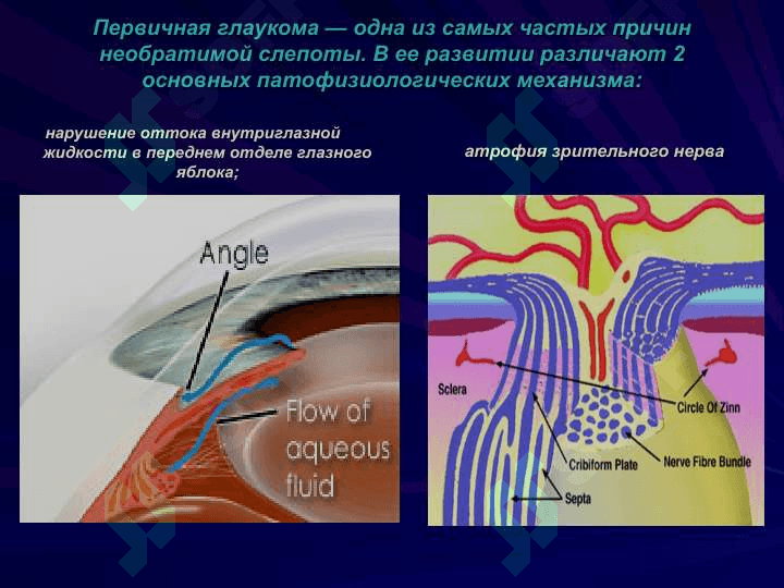 Глаукома 8