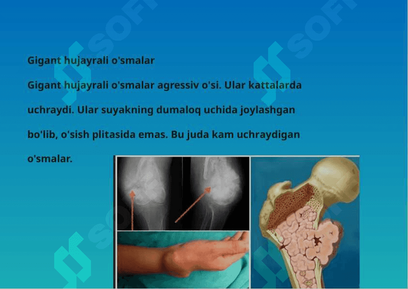 suyak to'qimasini o'smasi 7