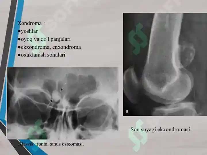 Suyakning xavfli va xavfsiz o'smalar 3