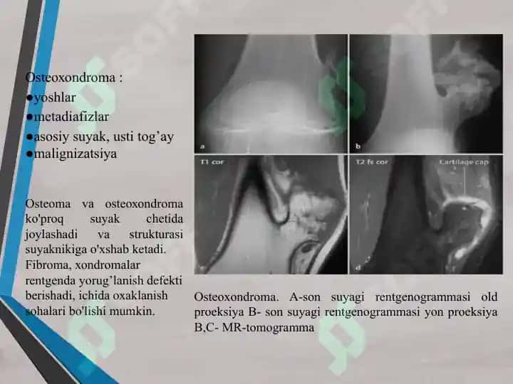 Suyakning xavfli va xavfsiz o'smalar 4