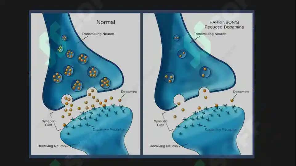 Parkinson kasalligini davolashda qo'llaniladigan dori vositalari 4