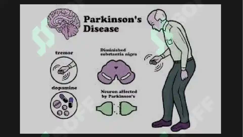 Parkinson kasalligini davolashda qo'llaniladigan dori vositalari 6