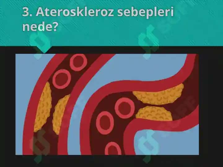 Ateroskleroz rivojlanishi 4