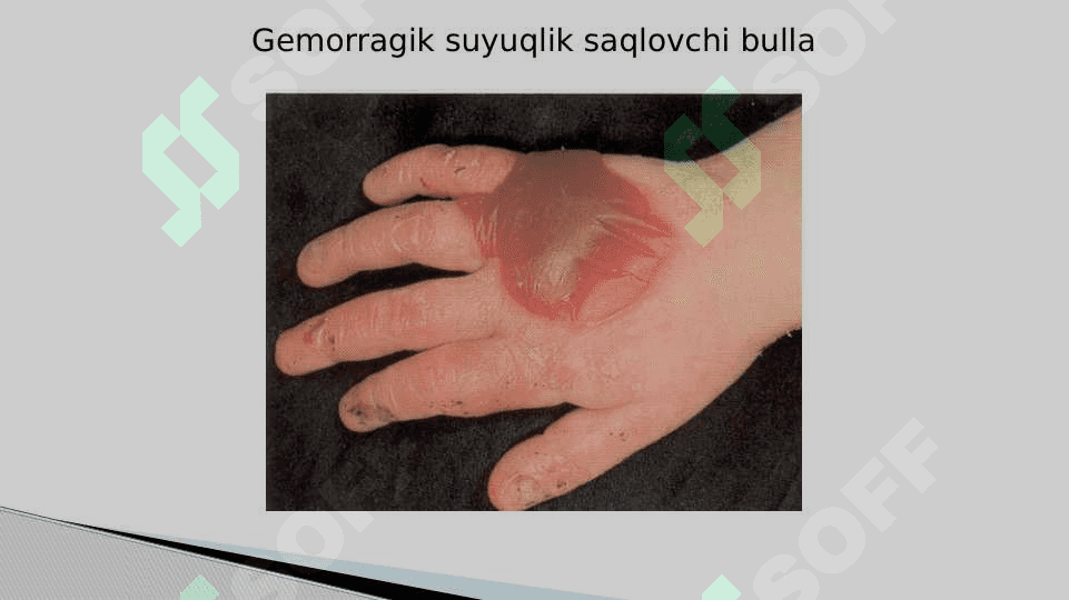 Bolalarda teri, teri osti yog’ qavatining  xususiyatlari 8