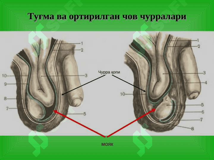 Чов, сон, киндик ва    қорин оқ чизиғи           чурралари 8