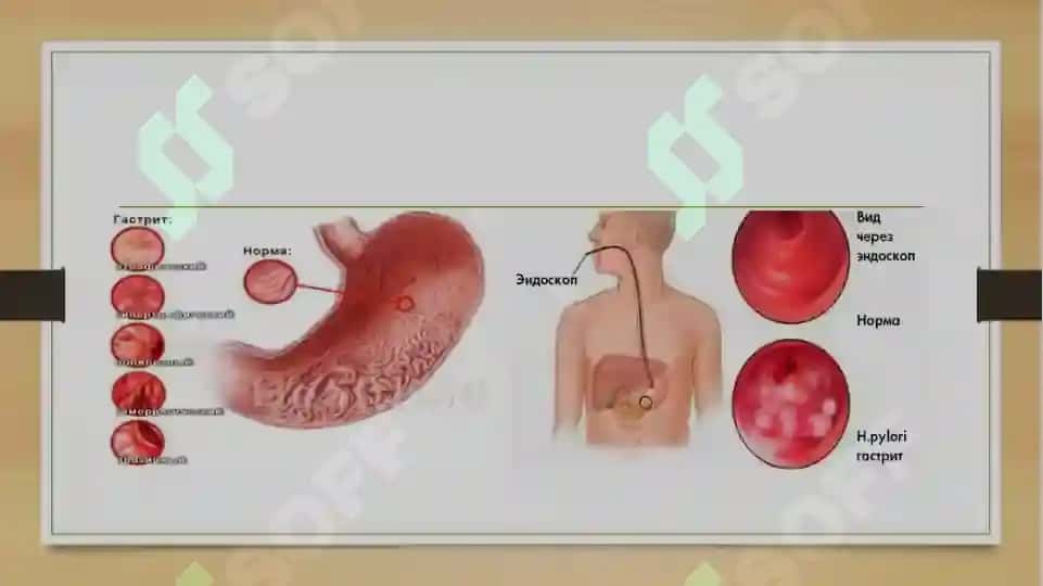 Gastrit 7